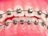 Ozone Glide III SLB Brackets